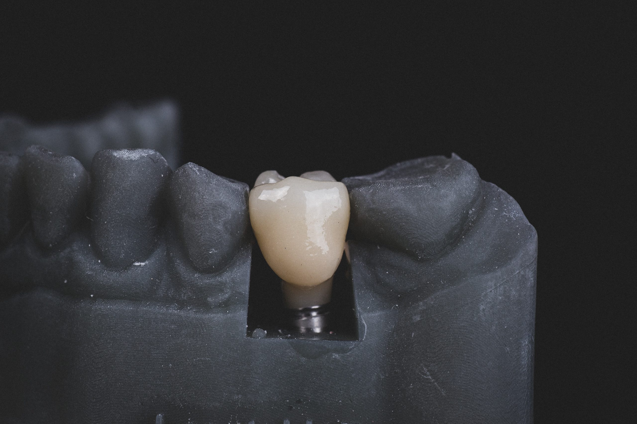 Dental Implants: The Ideal Solution for Restoring Smiles
