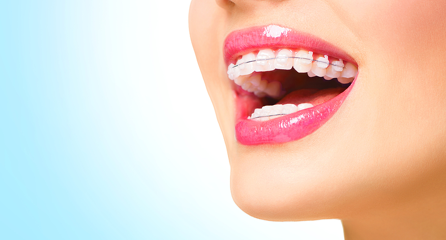 5 Surprising Benefits of Teeth Whitening Beyond Aesthetics