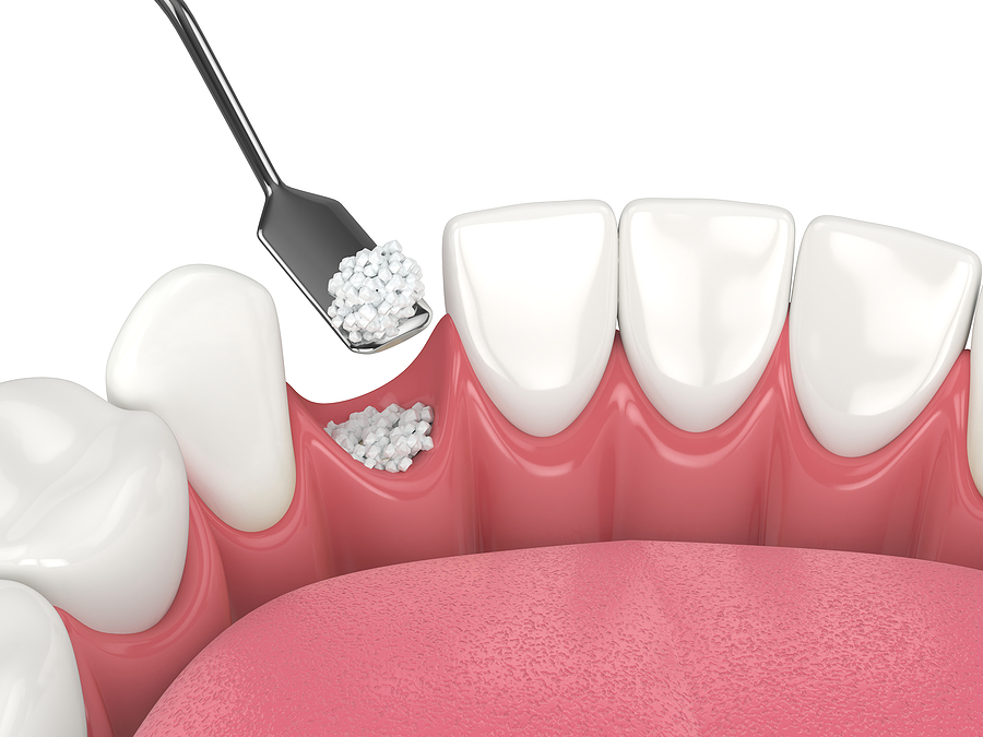 Bone Grafting in Aurora, CO: Restoring Jawbone Health for a Stronger Smile