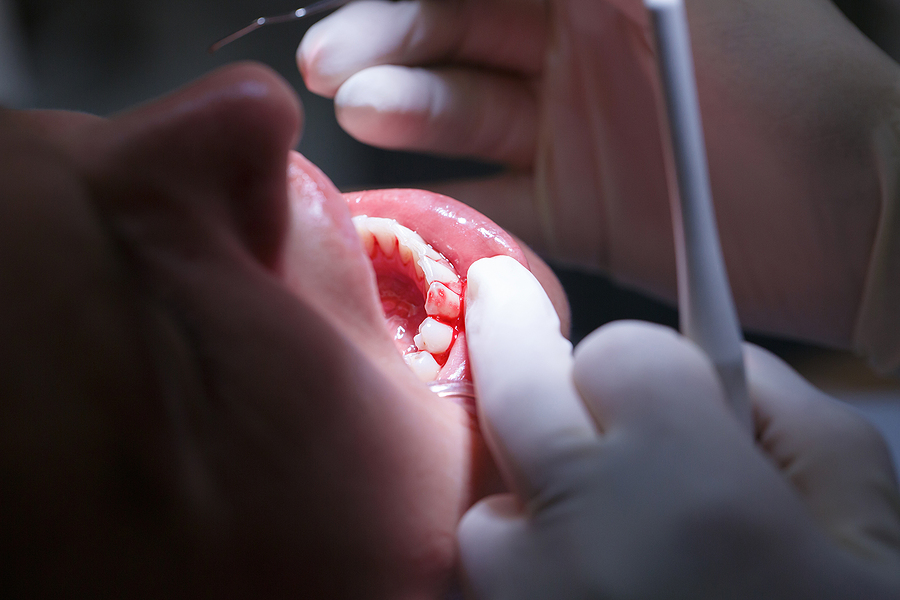 Understanding Periodontal Disease: Causes, Symptoms, and Treatment